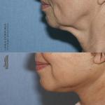 60-letnia pacjentka przed i 3 tygodnie po liftingu twarzy.