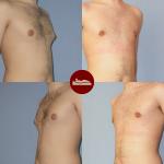 23-letni pacjent przed i miesiąc po korekcji niewielkiego stopnia ginekomastii za pomocą liposuction.