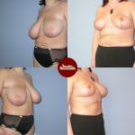 36-letnia pacjentka przed i miesiąc po plastyce zmniejszeniu piersi z cięcia pionowego. Z każdej piersi usunięto ok 800g.